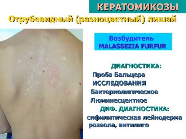 Как выглядят различные формы заболевания?