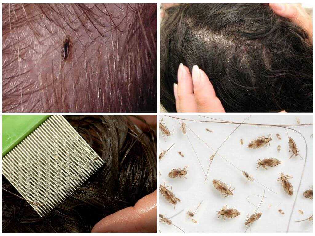 Как выглядят живые вши?