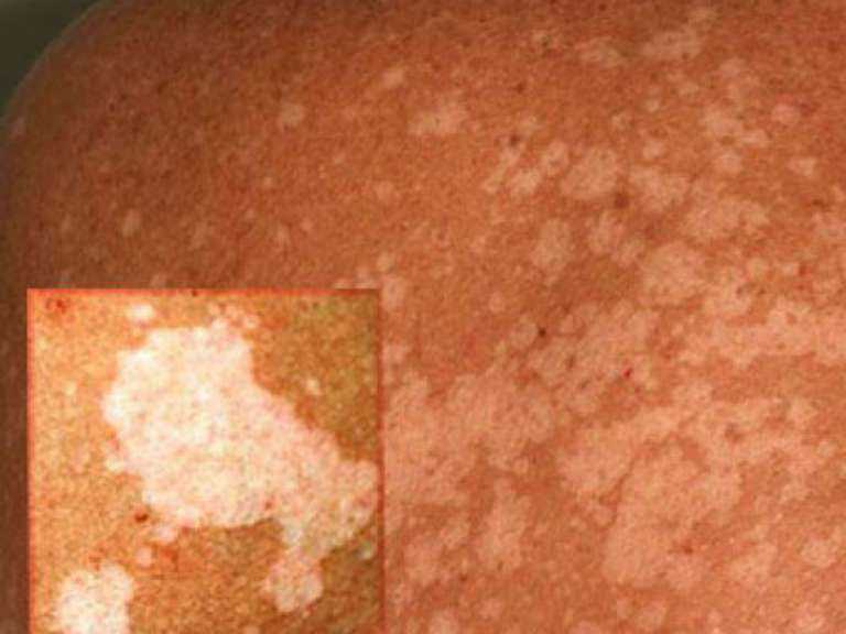 Лишай фото у человека: симптомы, лечение и профилактика Лишай фото у человека: симптомы, лечение и профилактика