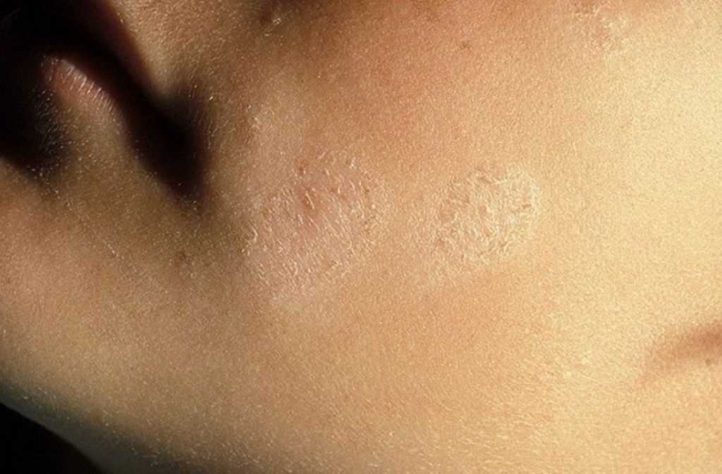 Лишай у человека: как выглядят фото признаки и как справиться с болезнью Лишай у человека: как выглядят фото признаки и как справиться с болезнью