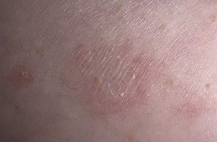 Народные средства борьбы с лишаем