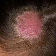 Лишай зостер