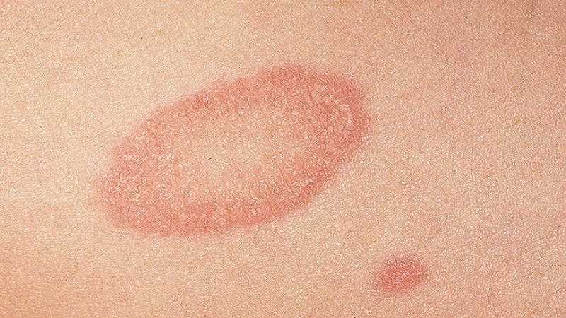 Симптомы и признаки лишая