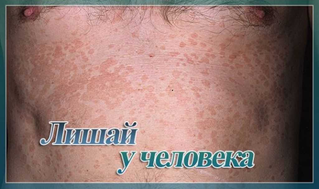 Основные симптомы и узнавание заболевания на фото