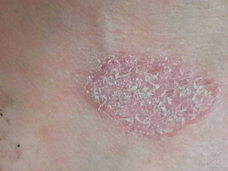 Медикаментозное лечение